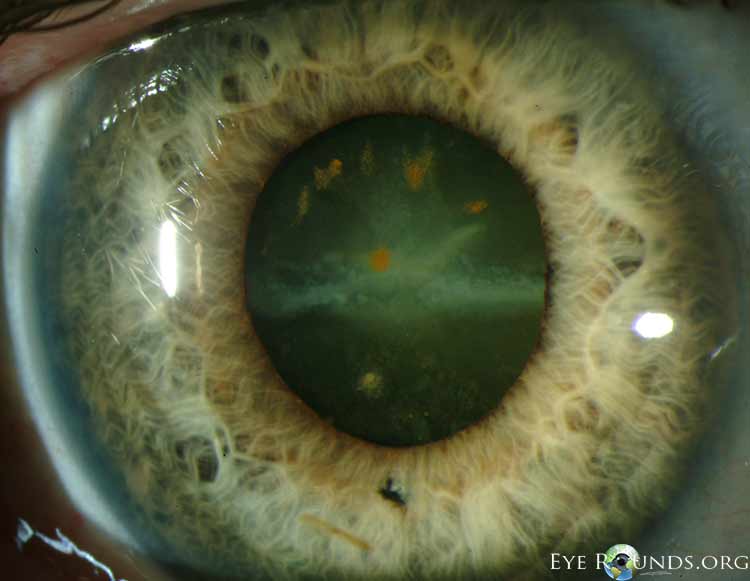 Sarcoid Uveitis