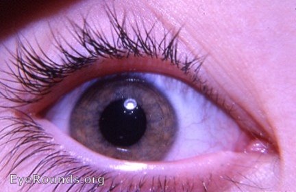 Heterochromia with Horner's syndrome. Normal OS is brown