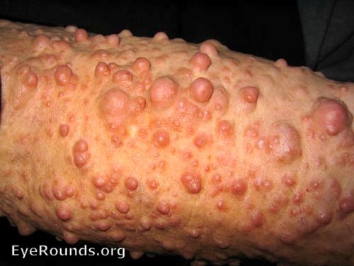 neurofibromatosis type 1 (NF-1) Lisch Nodules