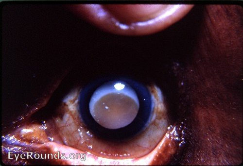Perfect photograph of the classic hypermature Morgagnian cataract