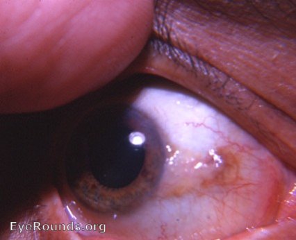 conjunctiva: pinguecula