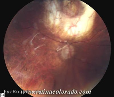 Rubeosis associated with Retinal Detachment