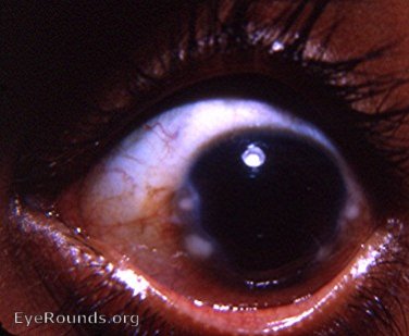 Salzmann's nodular degeneration/dystrophy of the cornea