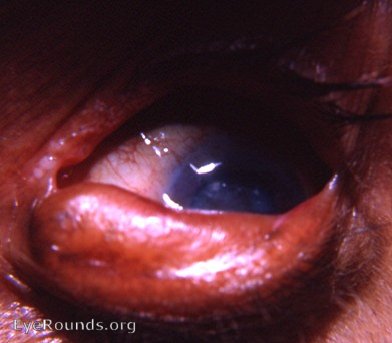 epidermalization of palpebral conjunctiva