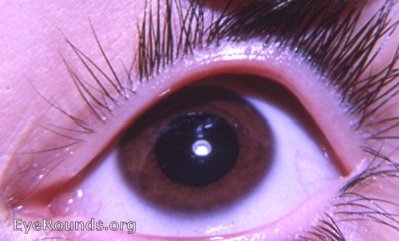 Heterochromia with Horner's syndrome. Normal OS is brown