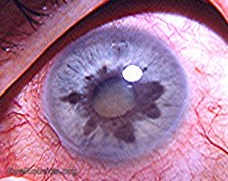 heterochromia iridis caused by chronic cyclitis