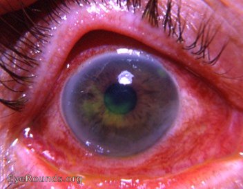 dendritic keratitis - stained