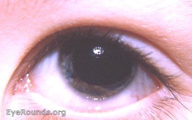 hypoplasia of the iris