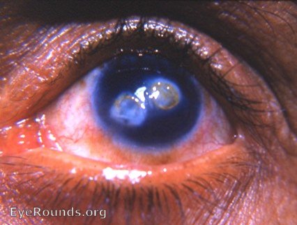 leukomatous corneal ulcer scars with fatty infiltration