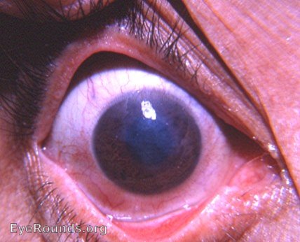 corneal macular scar with neovascularization of the superior cornea
