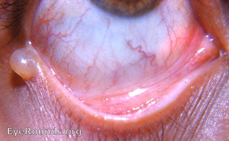 Cyst: cyst of gland of Moll; also, papilloma upper lid