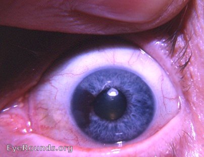 differential diagnosis of a heavily pigmented iris lesion