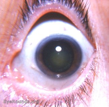 cataract: nuclear sclerosis vs nuclear cataract