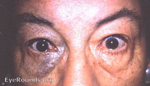 nevus of Ota : definite in grandmother, ? in grandson