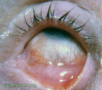 ocular pemphigoid or essential shrinkage of the conjunctiva