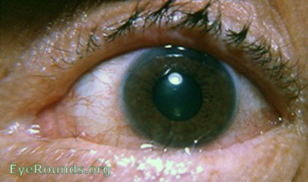 ocular pemphigoid or essential shrinkage of the conjunctiva