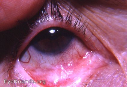 trachoma: pemphigoid-like trachoma with trichiasis