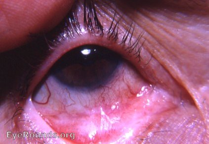 cyst: meibomian gland retention cyst with pemphigoid