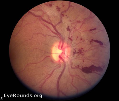 regressing proliferative diabetic retinopathy after PRP laser