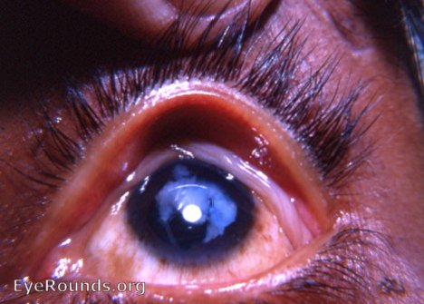 Cataract: aftercataract ( secondary cataract ) following needling ( discission )