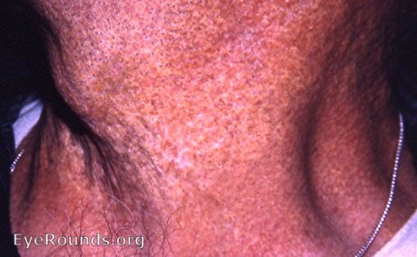 skin manifestation of Groenblad-Strandberg syndrome