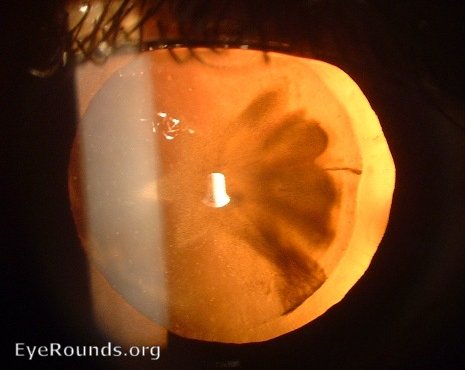 traumatic rosette cataract seen in fundal retroillumination
