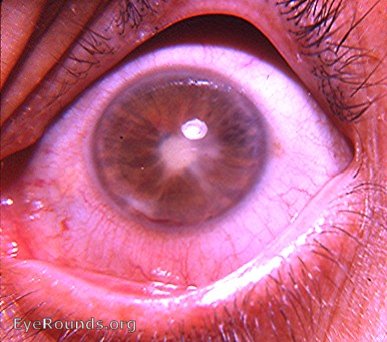 rubeosis iridis, hyphema, iris atrophy, and cataracta complicata