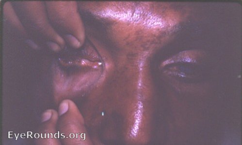 cornea: smallpox with symblepharon to cornea and bulbar conjunctiva OD