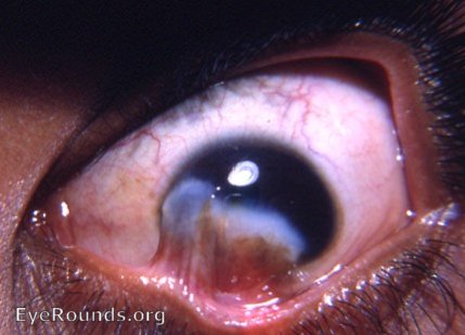 cornea: smallpox with symblepharon to cornea and bulbar conjunctiva OD