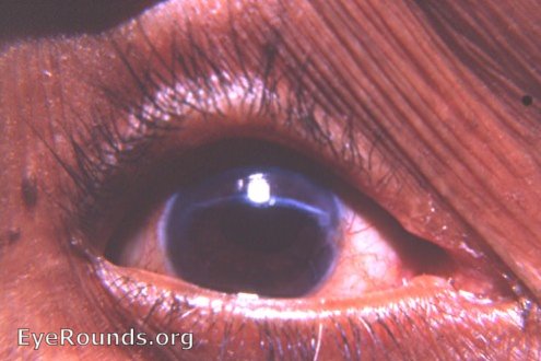 cataract: a von Graefe knife incision that went astrat. In spite of its improper placement and the use of no sutures, the wound healed perfectly. 