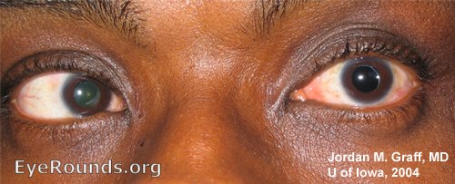Atlas Entry - 6th nerve palsy, left eye