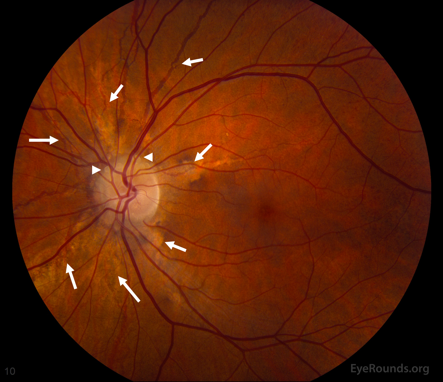 Angioid Streaks and Optic Disc Drusen in Pseudoxanthoma Elasticum The