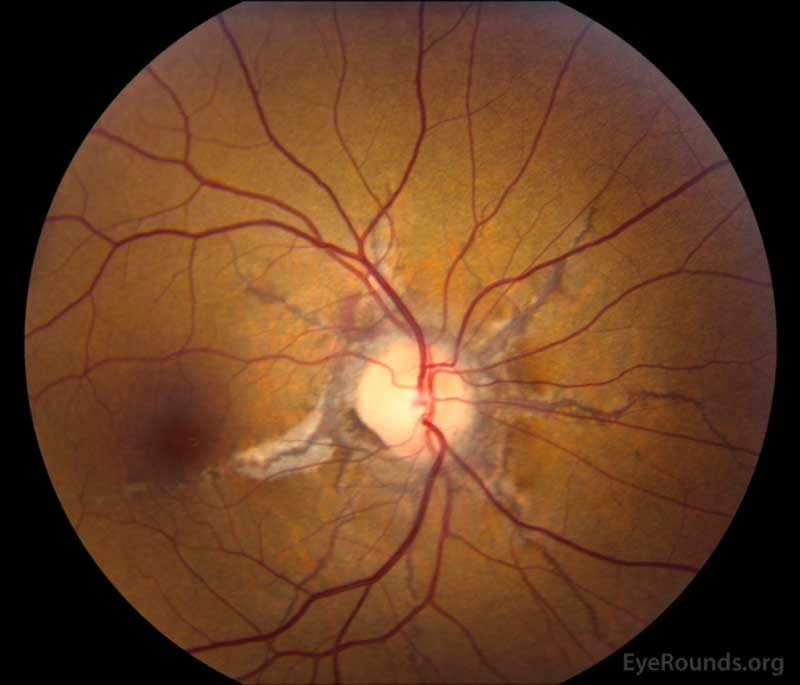 Angioid Streaks and Optic Disc Drusen in Pseudoxanthoma Elasticum The