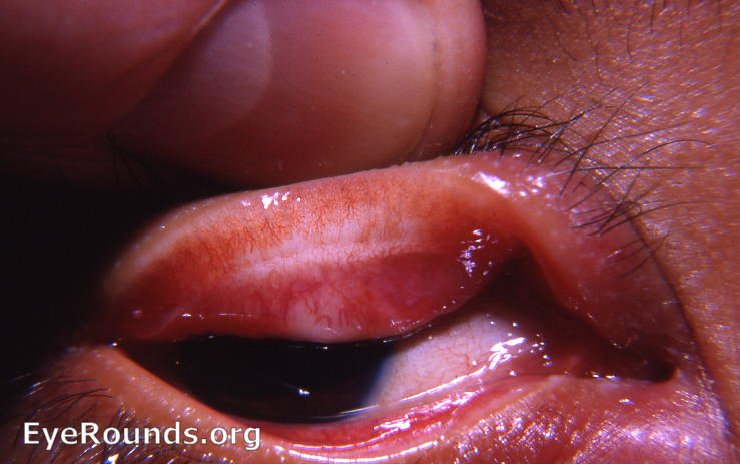 Trachoma