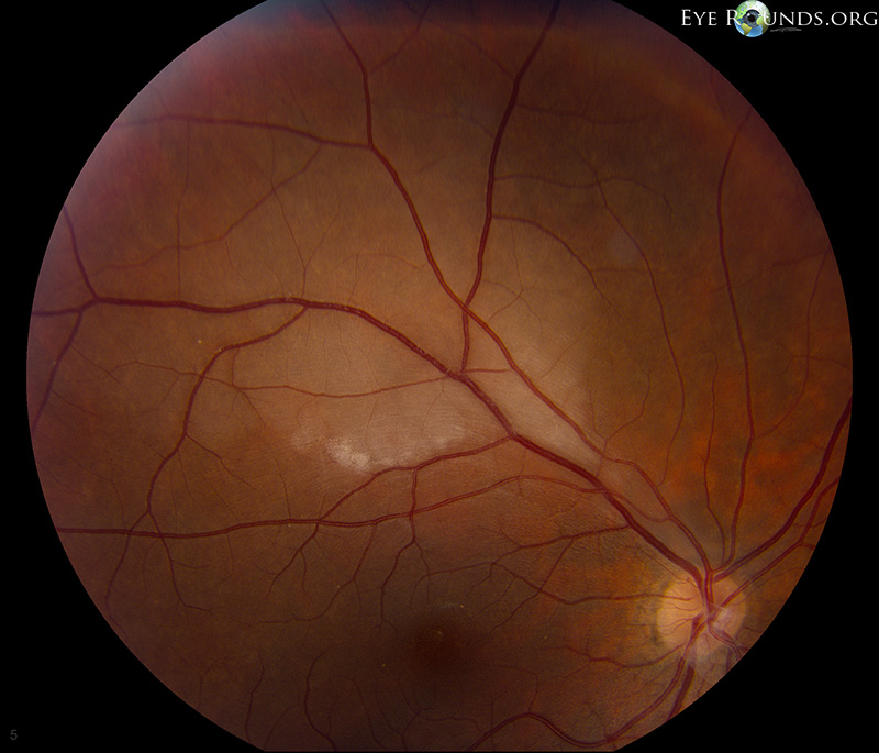 Branch Retinal Artery Occlusion