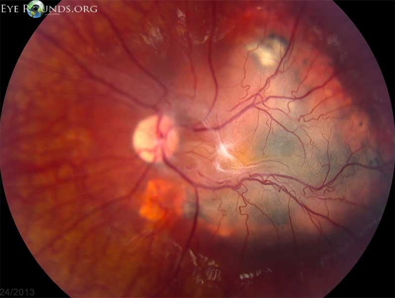 arterioles and venules appeared to dive into the lesion temporal to fovea, but were now less dilated than previously