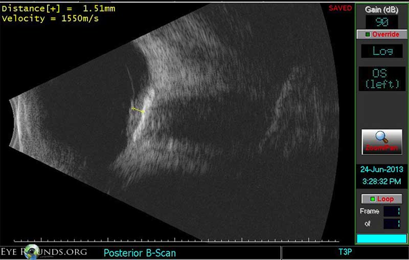 . Echography of the left eye