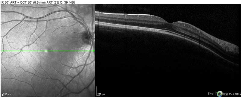 OCT of right eye, normal