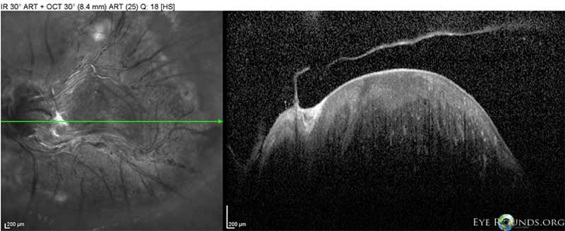 OCT of left eye