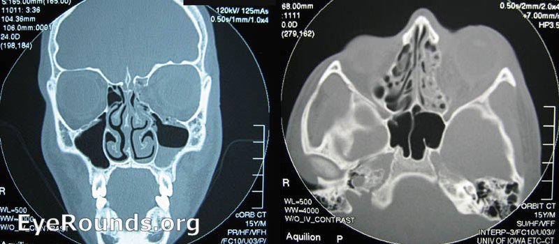 Orbital fractures and trauma. EyeRounds.org: Online Ophthalmic Atlas