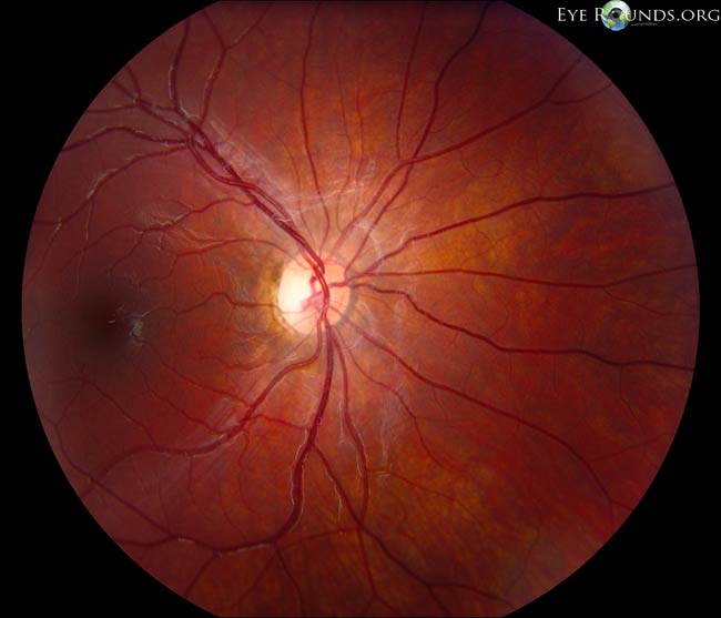 Dominant Optic Atrophy