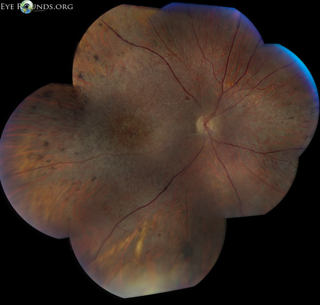 Erosive Vitreoretinopathy, right eye