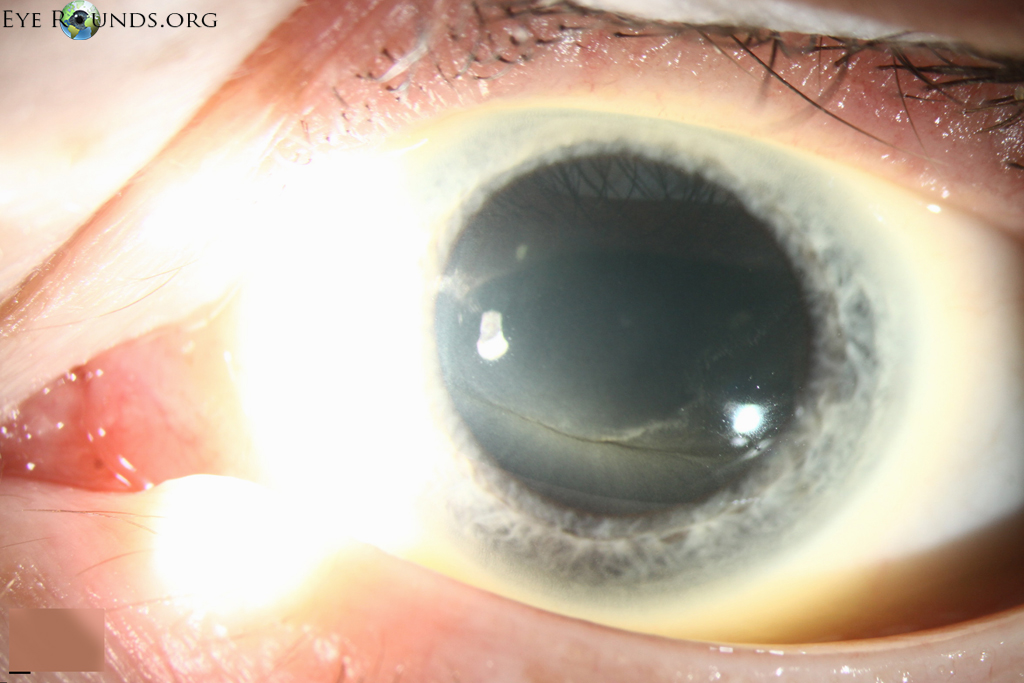 Atlas entry fabry disease
