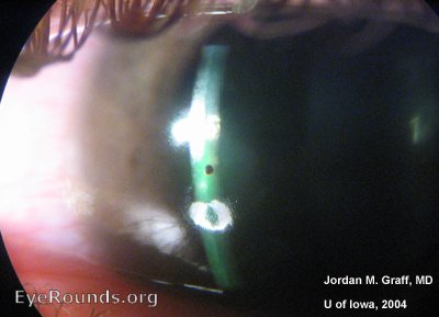 Slit lamp showing foreign rust ring