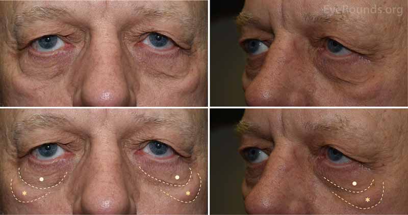 External photograph demonstrating bilateral malar mounds along the inferior orbital rim and cheek (asterisks). Note the separate presence of lower eyelid dermatochalasis (LED) on the lower eyelids (dots) superior to the malar mounds.