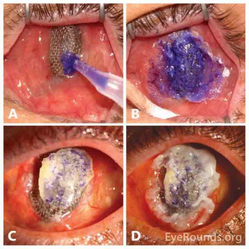 Cyanoacrylate glue was applied to the exposed tantalum implant surface. (Fig. A, B). The full extent of the exposure was appreciated after cleaning of the implant surface (Fig. C). One week after the glue application, the patient's symptoms had resolved and there were no visible areas of residual exposure (Fig. D).