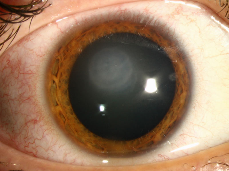 HSV disciform keratitis