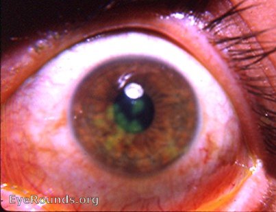 stained- herpes simplex I of the cornea