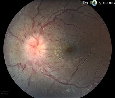 Idiopathic Intracranial Hypertension