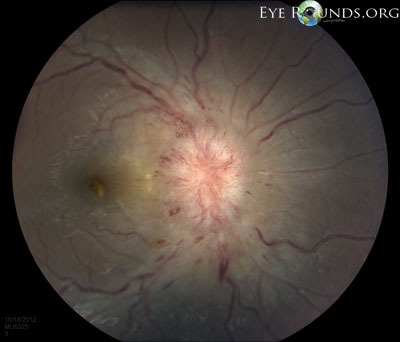 Idiopathic Intracranial Hypertension